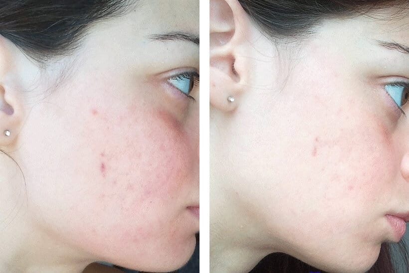 Skin Condition Before and After Using Manuka Honey