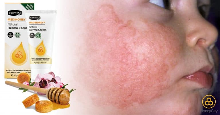 Exceptional Eczema Cure: How Manuka Honey Helps in Natural Skin Healing