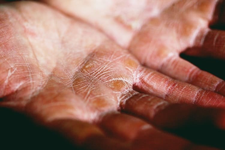 Eczema sufferer's dry and cracked palms