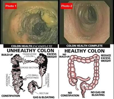 How a healthy and unhealthy colon looks like and how colon health affects you 