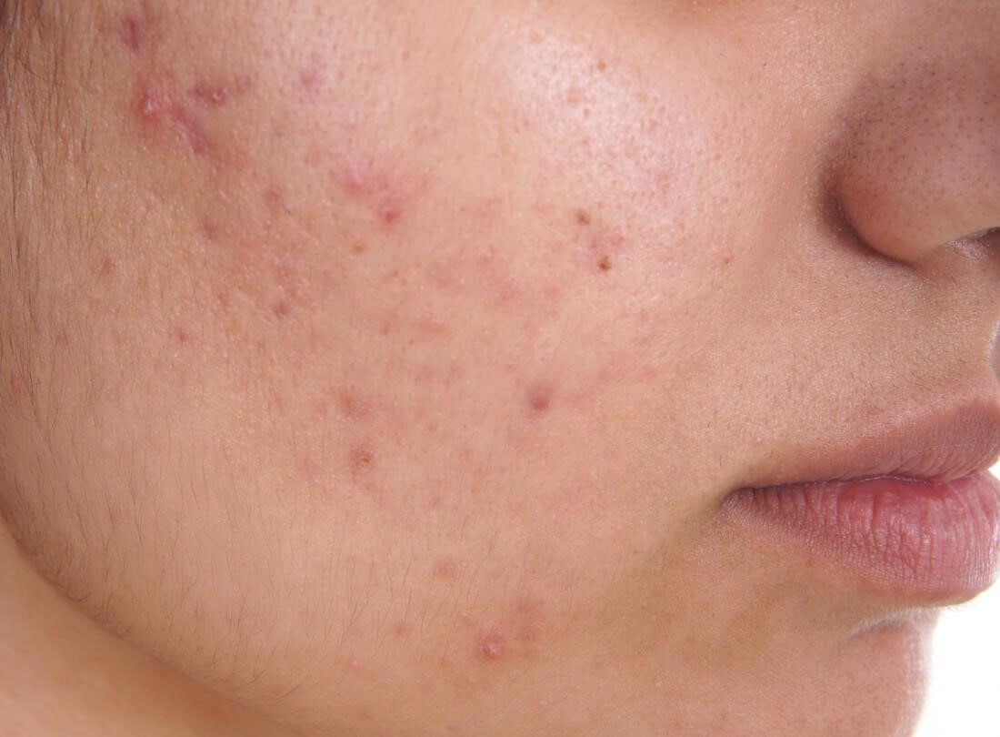 woman's face with acne blemishes