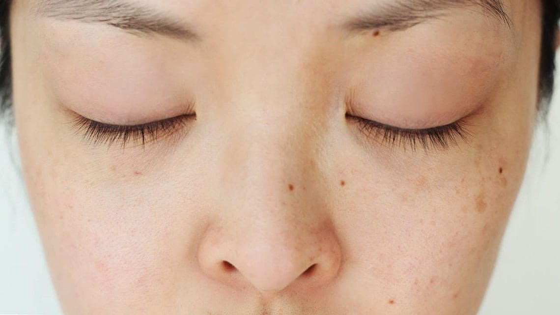 Woman with various dark spots on her face