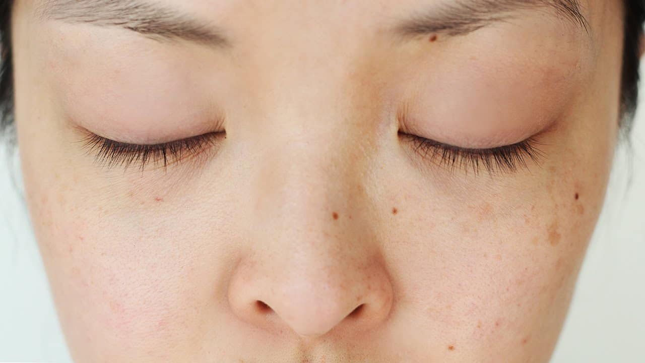 Woman with various dark spots on her face