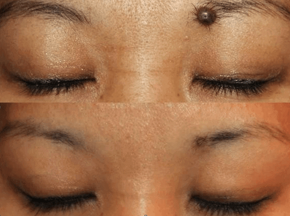Removal of a mole of a woman's face 