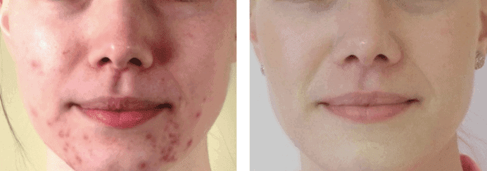 Before and after transition of a woman with acne on her face