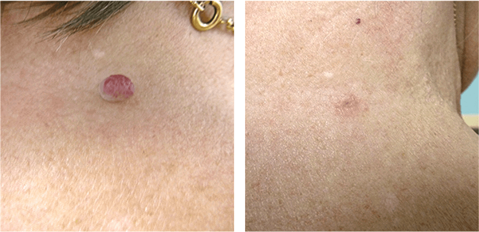 Removed Skin Tags on the Nape of the Neck 