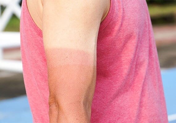 Sunburnt arm of a man in a red singlet